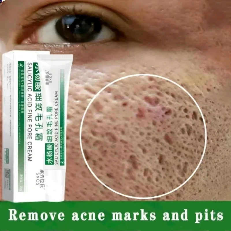 Salicylic Acid Blackhead Remover - Salicylsäure Poren Clearing Creme Schrumpfen Poren