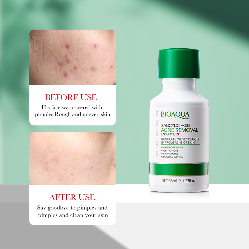 35 ml BIOAOUA Salicylsäure Ant – Salicylic Acid Blackhead Remover Bewertung und Preis